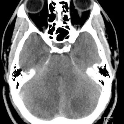 Dr. Morgan - Complex Stroke Case Study