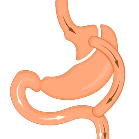 Bypass Surgery Illustration