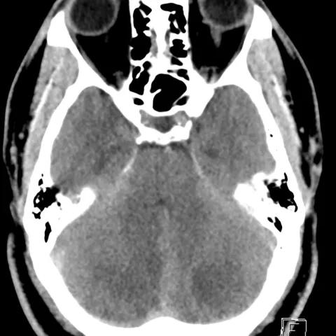 Dr. Morgan - Complex Stroke Case Study