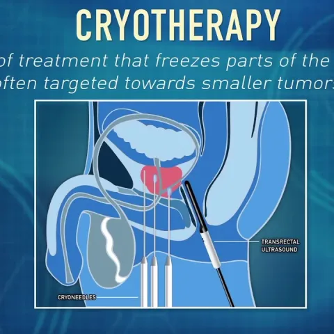 What is Cryotherapy? | Global Robotics Institute | AdventHealth