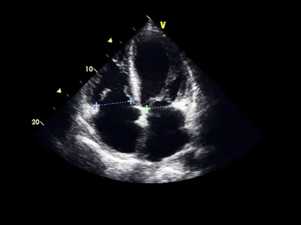 transesophageal-echocardiogram