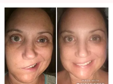 Ramsay Hunt Syndrome