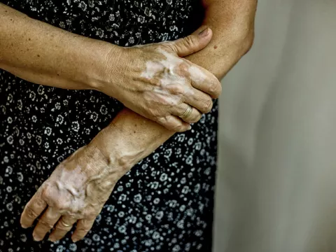 autoimmune-disorders-whi-blog