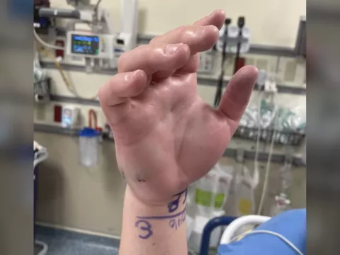A water moccasin bit Marcus Engel's right hand.