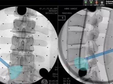 Endoscopic Spine Surgery
