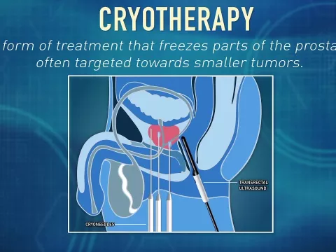 What is Cryotherapy? | Global Robotics Institute | AdventHealth