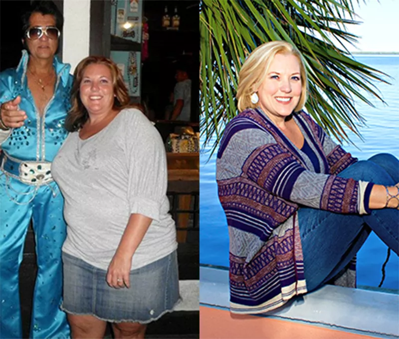 Jennifer Before and After Bariatric Surgery.
