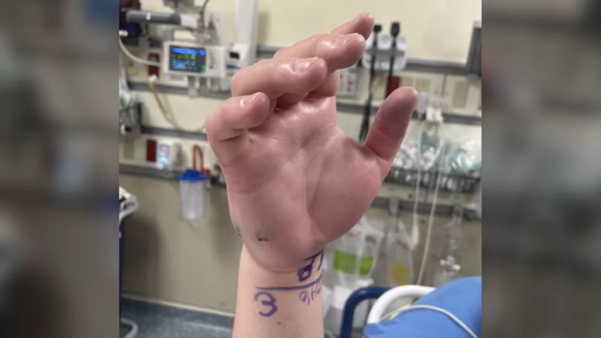 A water moccasin bit Marcus Engel's right hand.