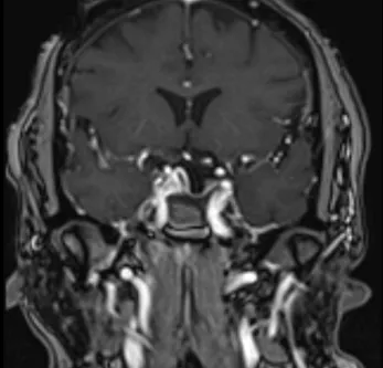 Post-Op Pituitary Tumor Surgery Image 2