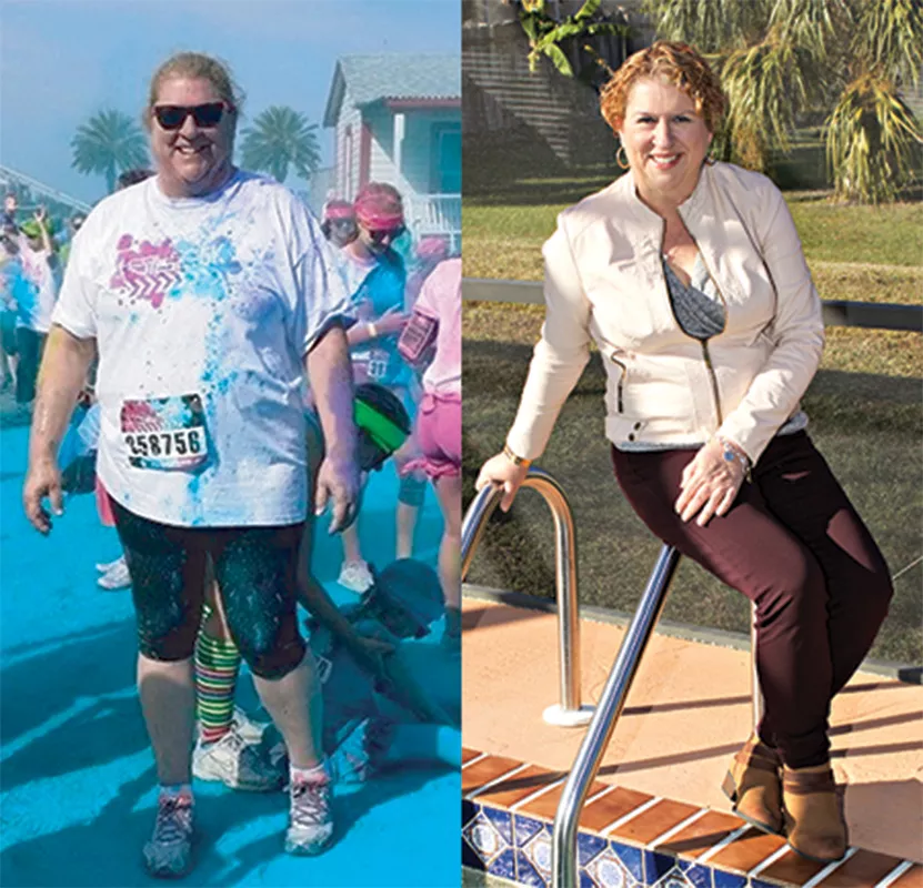 Rebecca Shilling Before and After Bariatric Surgery.
