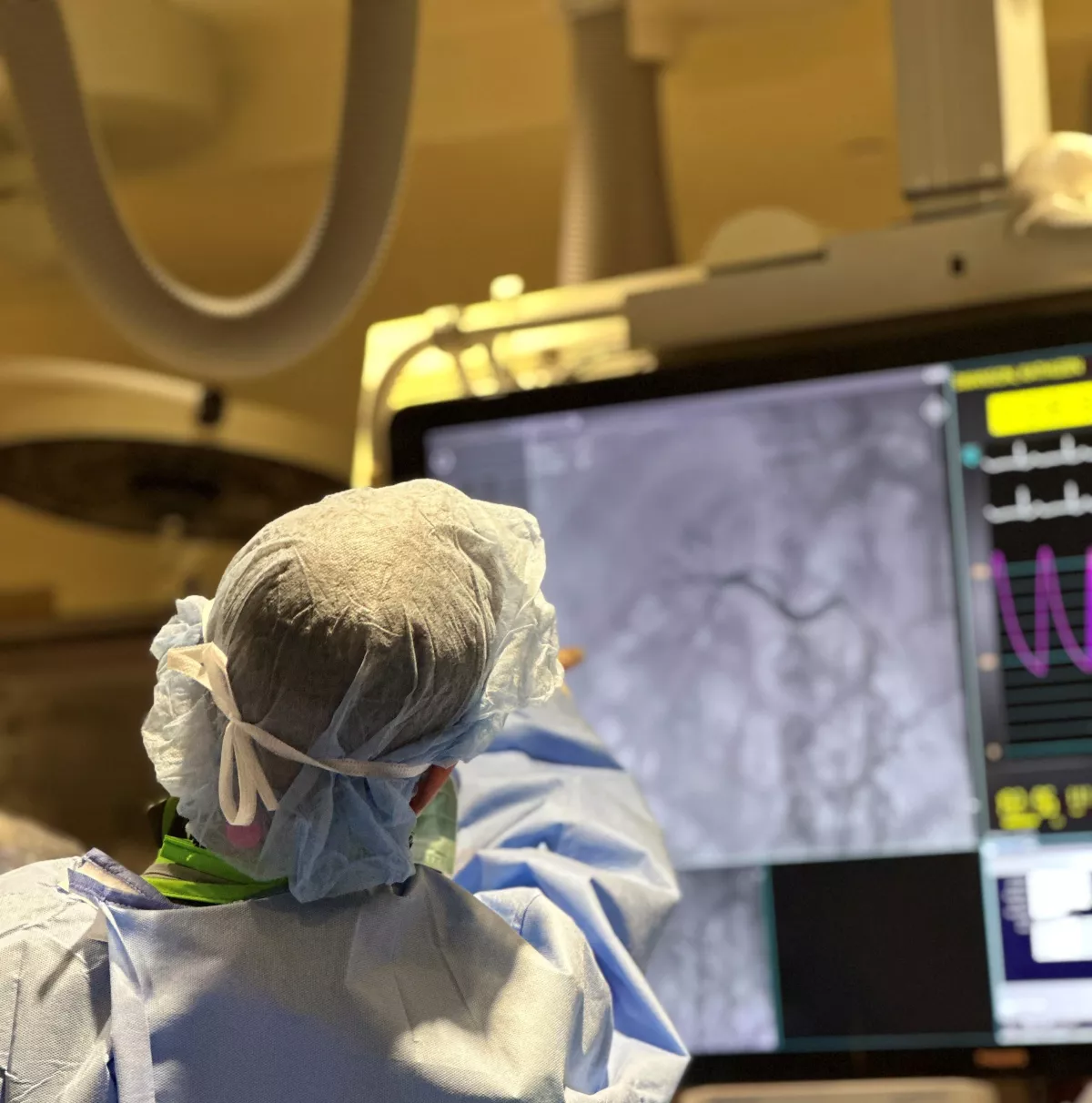 Doctors at AdventHealth Wesley Chapel are the first in Pasco County to perform a renal denervation procedure with Symplicity.